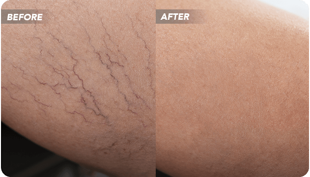 What are  Spider Veins?