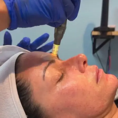 Microneedling / Facial