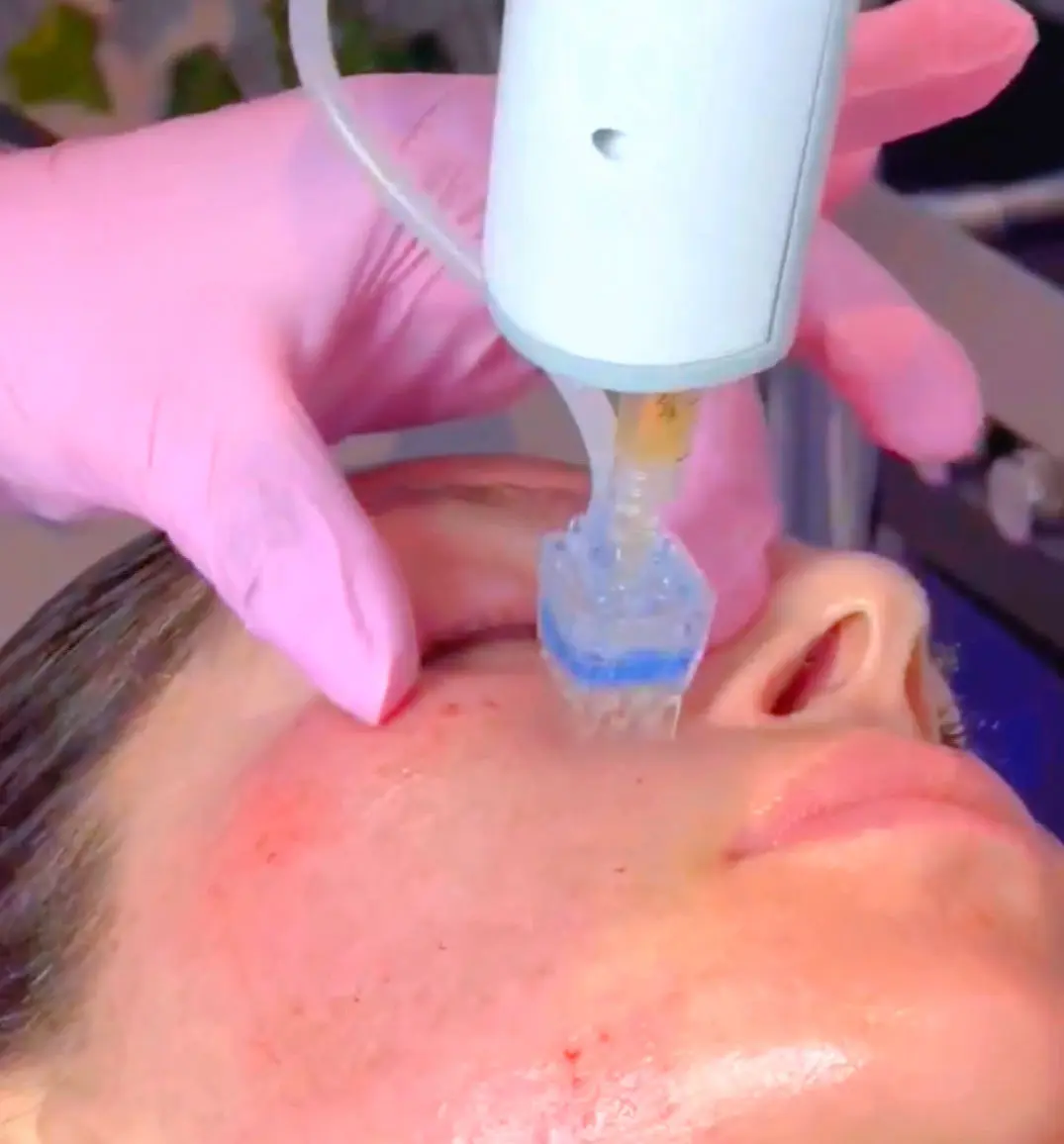 PRP microneedling